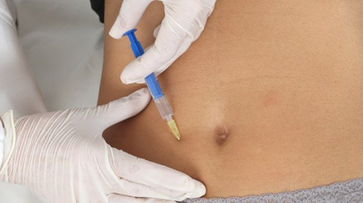 Mesoterapia